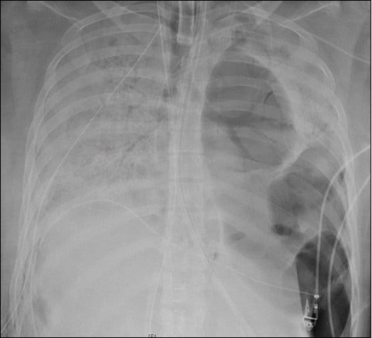 An X-ray of the patient’s lungs before surgery. Northwestern Medicine