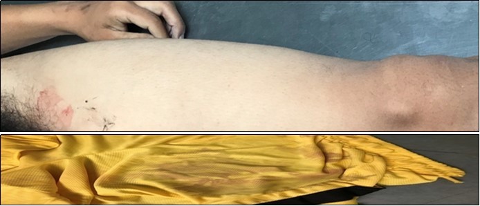 Blood stain on thigh and on inner garment