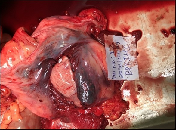 Ruptured Urinary Bladder