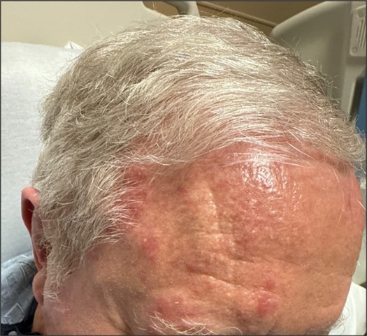 Figure 1. Unilateral vesicular rash across the right forehead tender to palpation.