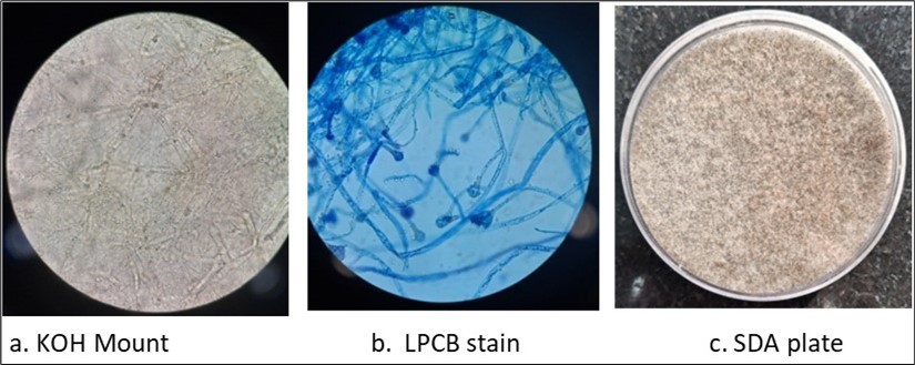 Figure 2. Microbiological findings suggestive of mucormycosis