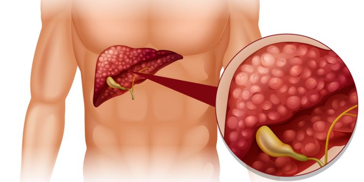 Article: Pyrexia And Liver Injury After A Second SARS-CoV-2 Vaccination: Macrophage Activation Manifested In Liver