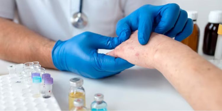 Article: A case of delayed allergy after cyanoacrylate closure of varicose veins, diagnosed by drug-induced                 lymphocyte stimulation test